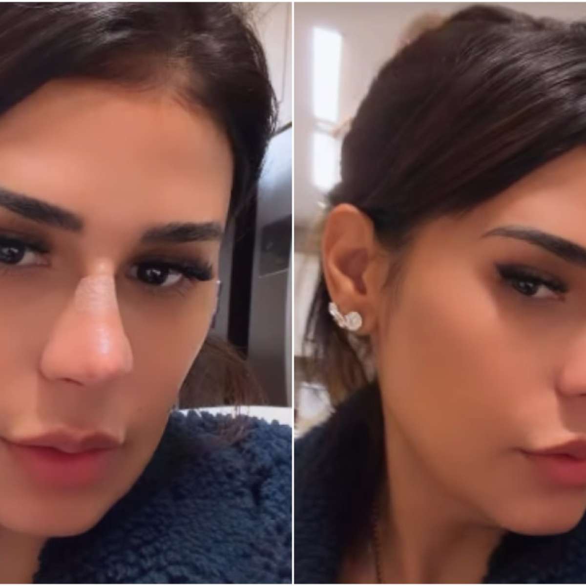 Simone Mendes fez plástica no nariz? Cantora revela procedimento realizado